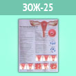 Плакат «Что такое рак шейки матки?» (ЗОЖ-25, ламинированная бумага, A2, 1 лист)